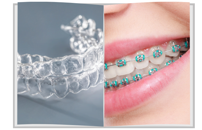 Braces Vs Aligners